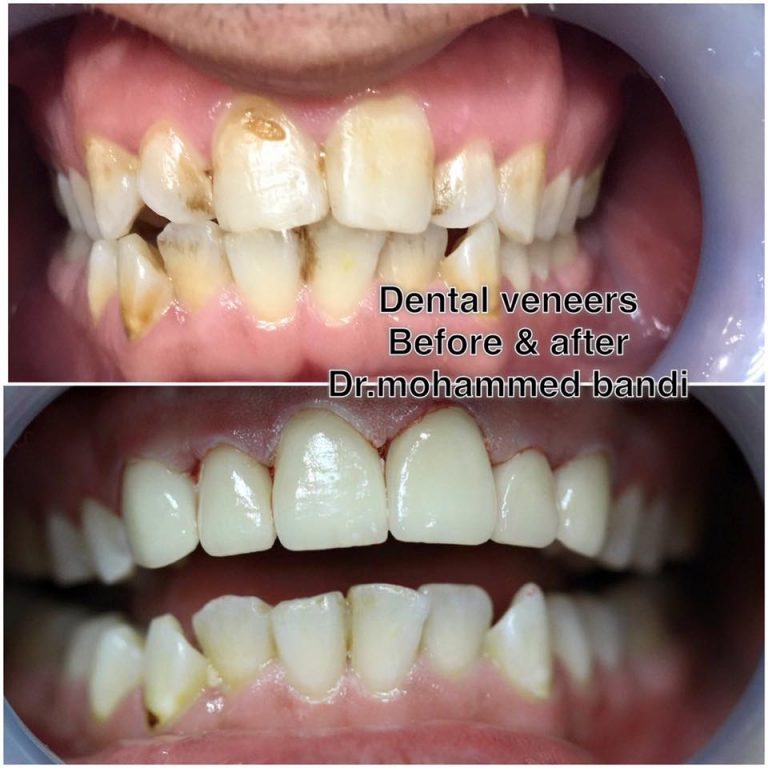 ابتسامة هوليود - مركز گرنژين لطب الأسنان